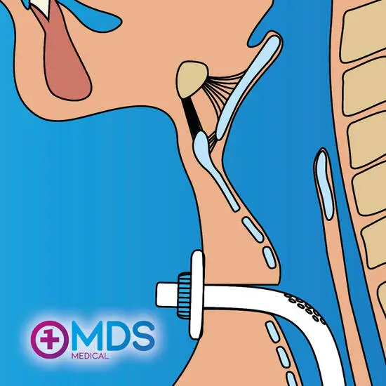 De impact van tracheotomie op patiënten en zorgverleners in de medische sector